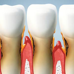 Parodontologie in unserer Zahnarztpraxis in Nürnberg